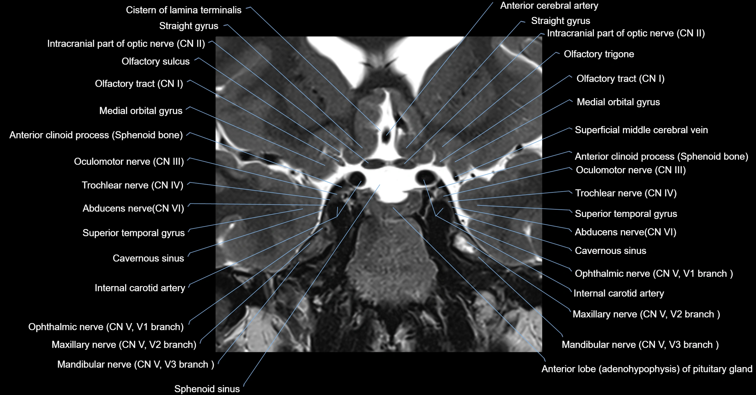 MRI cavernous sinus coronal cross sectional 3T anatomy image-img-00001-00010.webp